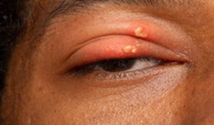 Underlivet herpes Herpes: Symptoms,